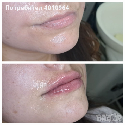 Дермални филъри, снимка 11 - Друго - 44934064