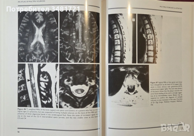 Голям атлас на множествената склероза / An Atlas of Multiple Sclerosis, снимка 13 - Специализирана литература - 53748194