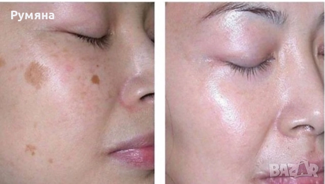 Пчелен мехлем срещу пигментни петна , снимка 4 - Други - 49271744