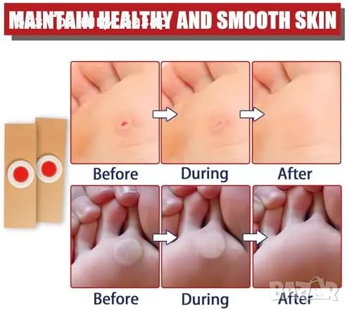 Нови 12 броя лепенки за мазоли и брадавици – ефективно премахване, снимка 2 - Други - 49537323