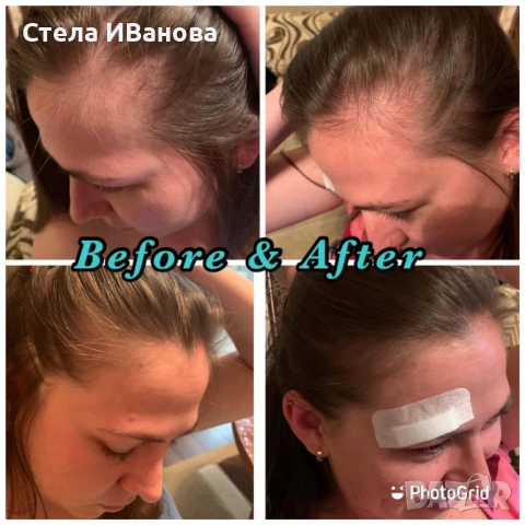 Комплект за бърз растеж на косата, при косопад, оплешивяване, алопеция, снимка 8 - Продукти за коса - 53222898