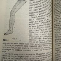 Разширени вени на долните крайници -Димитър Хаджиев,1977,стр.75, снимка 5 - Специализирана литература - 45384576