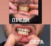 Писалка за избелване на зъби v34