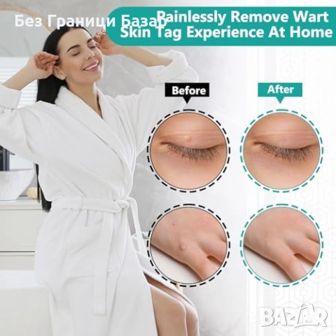 Нов Прецизен комплект за премахване на брадавици – безболезнен ефект, снимка 4 - Други - 52656175