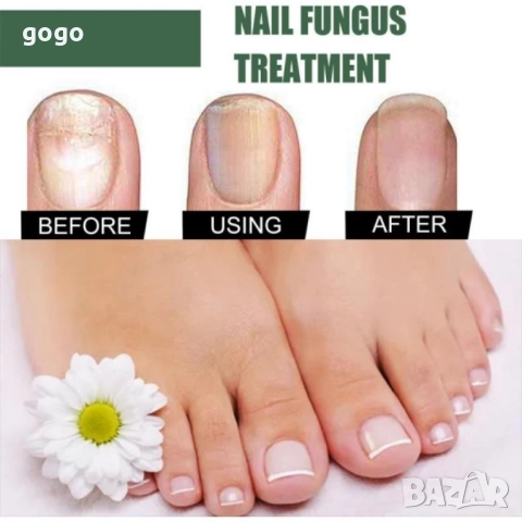 лак против гъбички , снимка 10 - Други - 51861216