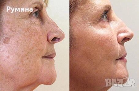 Пчелен мехлем срещу пигментни петна , снимка 5 - Други - 49271744