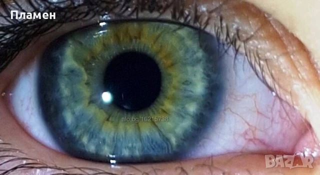 Ирисова диагностика