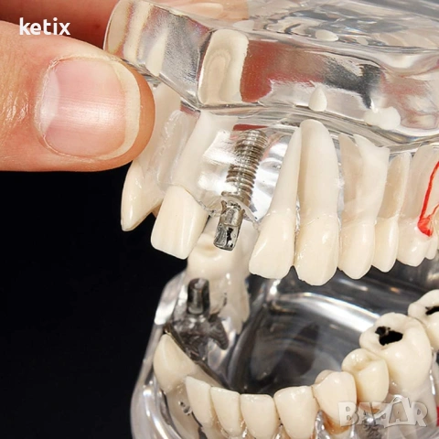 Дентален модел с реставрация, снимка 3 - Стоматология - 53018772