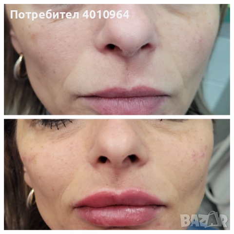  Дермални филъри, снимка 3 - Медицински, стоматологични - 52900689