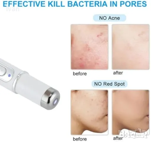 Уред за премахване на Акне и петна Acne fighting secret KD7910 , снимка 3 - Козметика за лице - 49832229