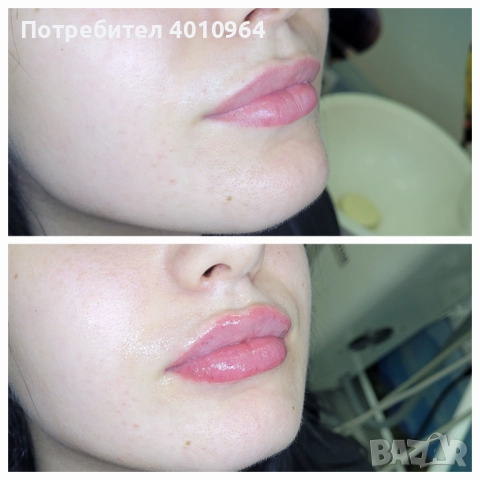 Дермални филъри, снимка 10 - Друго - 44934064