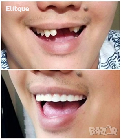 Instant Smile Lowers усмивка за минути  , снимка 11 - Други стоки за дома - 52906089