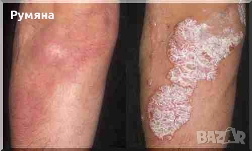 Пчелен мехлем срещу псориазис и екземи. , снимка 3 - Други - 49271882