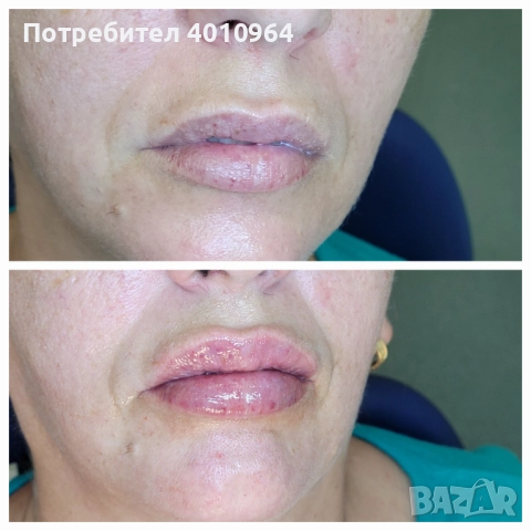 Дермални филъри, снимка 12 - Друго - 44934064