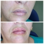 Дермални филъри, снимка 12