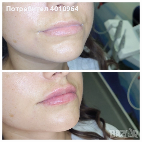  Дермални филъри, снимка 5 - Медицински, стоматологични - 52900689