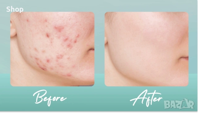 Крем против акне , снимка 8 - Козметика за лице - 53216256