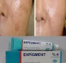 ПИГМЕНТНИ ПЕТНА ГАРАНТИРАМ ПРЕМАХВАНЕ с EXPIGMENT, снимка 3