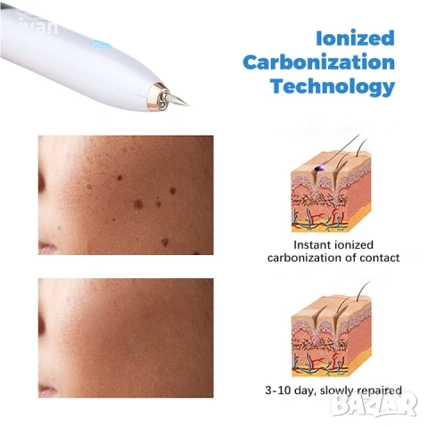 лазерна плазмена писалка с технология за йонизирана карбонизация за премахване на белези, снимка 4 - Други - 53306415