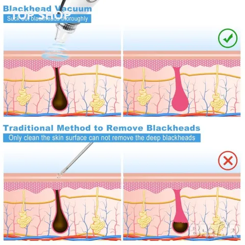 Vacuum blackhead remover премахване на черни точки, USB акумулаторен екстрактор на пъпки Tibobo, снимка 4 - Тримери - 48853564