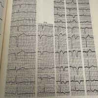 Електрокардиографичен атлас -А.Чернов, снимка 5 - Специализирана литература - 45316485
