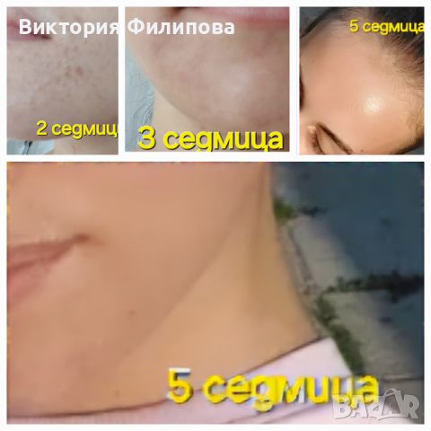 Комплект за АКНЕ КУПЕН ОТ САЙТ НА Oriflame 5 продукти за перфектна кожа за 5 седмици, снимка 3 - Козметика за лице - 46756675