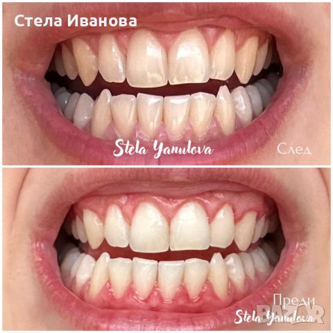 Паста за зъби против кървене на венците, парадонтоза, парадонтит, джобчета, кариеси, снимка 2 - Козметика за лице - 45170004