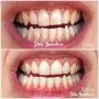 Паста за зъби против кървене на венците, парадонтоза, парадонтит, джобчета, кариеси, снимка 2