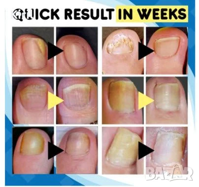 Лазер срещу - против гъбички по ноктите и акне комплект  , снимка 4 - Други - 50530090