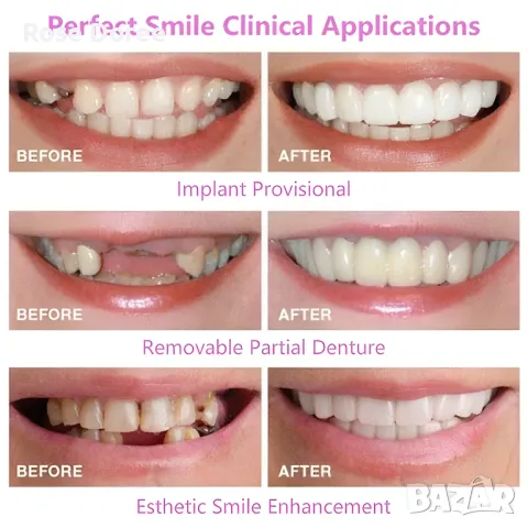 Естетически Персонализирани Фасети Протеза Изкуствени Зъби по мярка , снимка 5 - Други - 47179180