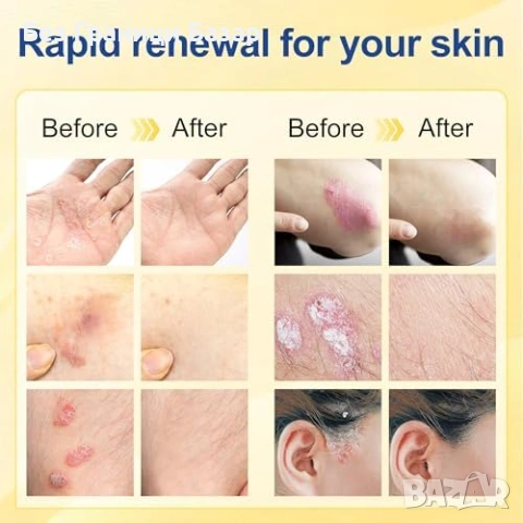 Нов Интензивен крем за суха кожа псориазис екзема лице и тяло Хидратиращ против сърбеж, снимка 5 - Други - 53973345