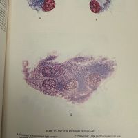Хематологичен Атлас-The Morphology of Human Blood Cells-Abbot laboratories,1985,p.92, снимка 10 - Специализирана литература - 45372137