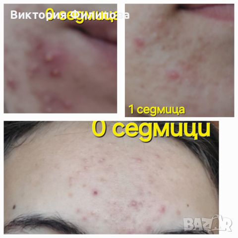 Комплект за АКНЕ КУПЕН ОТ САЙТ НА Oriflame 5 продукти за перфектна кожа за 5 седмици, снимка 2 - Козметика за лице - 46756675