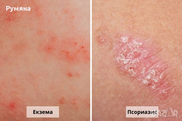 Пчелен мехлем срещу псориазис и екземи. , снимка 4 - Други - 49271882