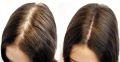 Косопад / оплешивяване /ранно побеляване на коса - натуропат - природна медицицина , снимка 1 - Медицински, стоматологични - 45394978