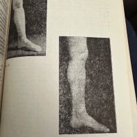 Разширени вени на долните крайници -Димитър Хаджиев,1977,стр.75, снимка 4 - Специализирана литература - 45384576